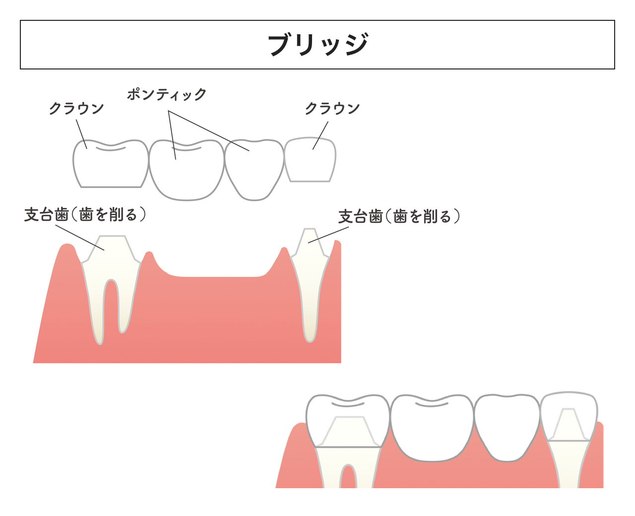 入れ歯説明イメージ