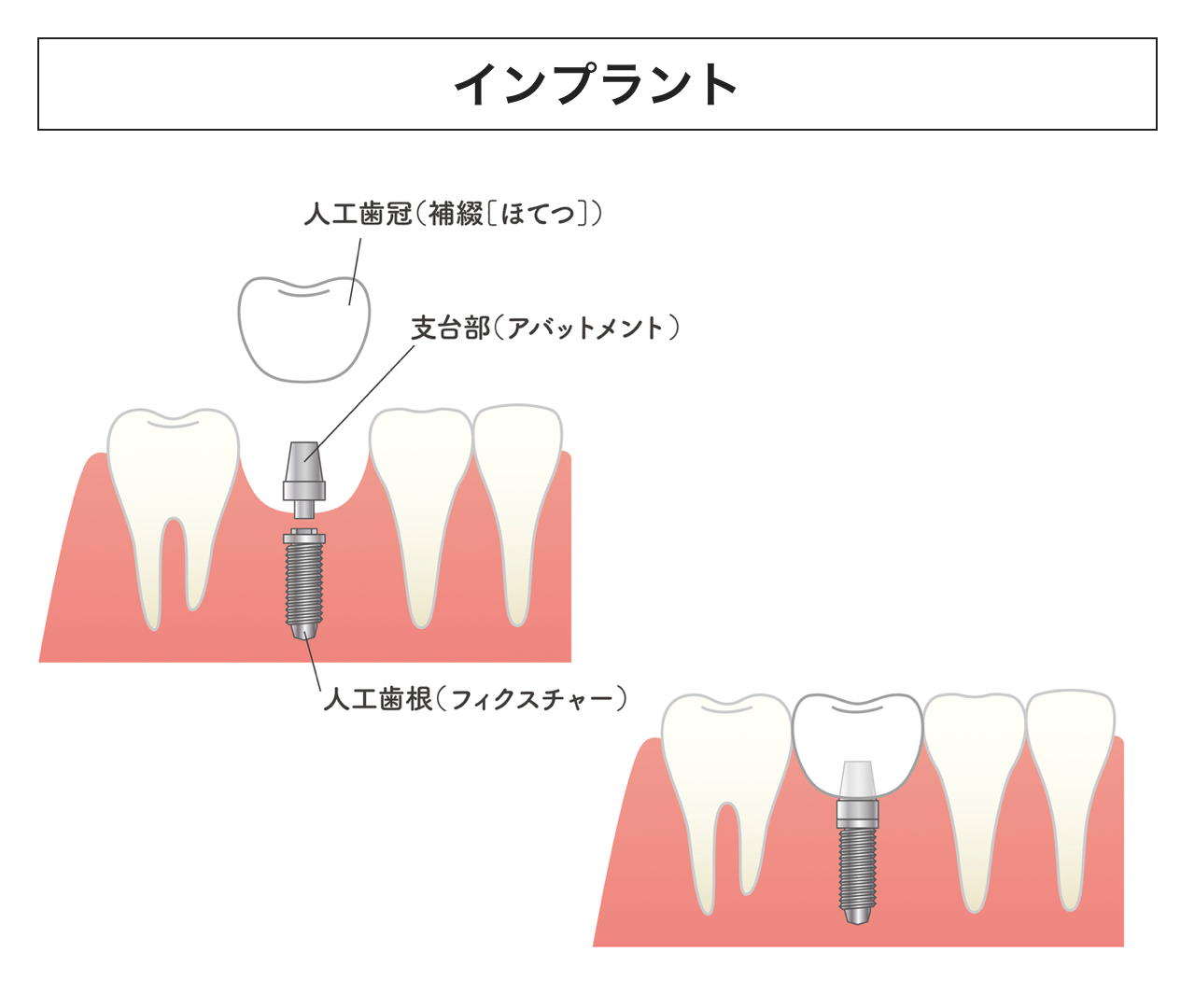 インプラント説明イメージ